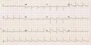 normal-sinus-rhythm
